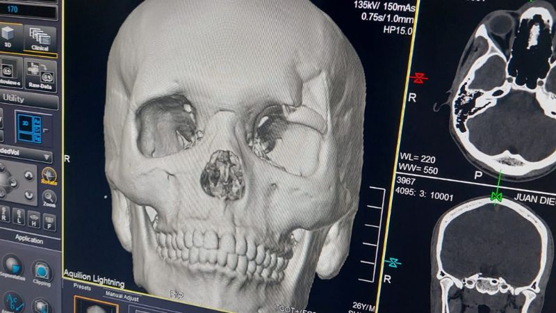 La radiografía practicada a Juan Lasso, muestra la lesión de cráneo. Fotos cortesía del periodista Samael Banegas.